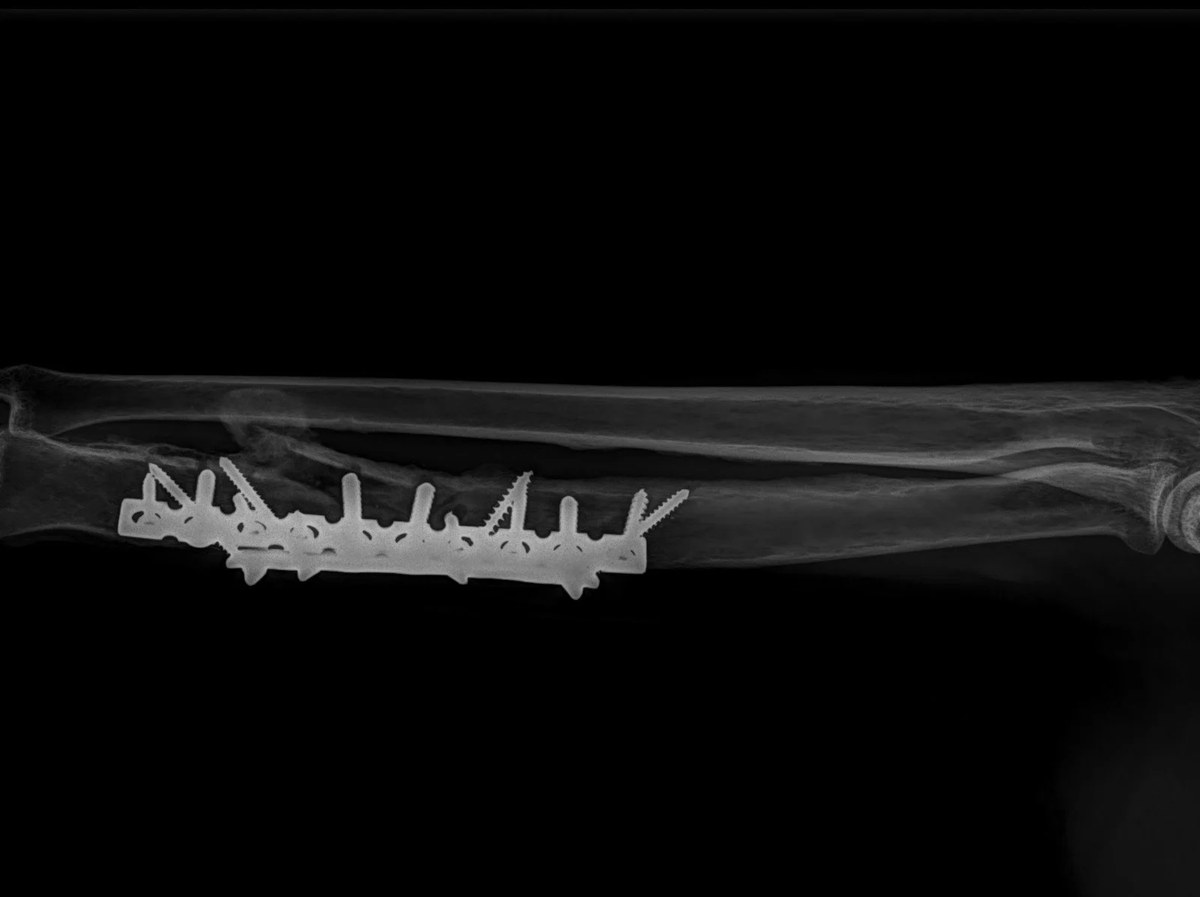 A radiograph of a primate forearm showing a long metal plate secured along the bone with a row of surgical screws, against a black background.